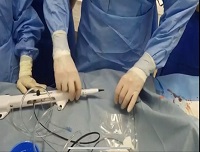 В Саратовском областном клиническом кардиологическом диспансере впервые в регионе проведена операция с использованием системы Rotablator