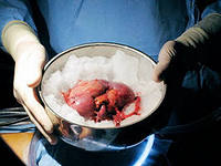 В Областной клинической больнице проведена еще одна операция по трансплантации почки от кадаверного донора