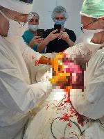 Врачи Балаковской городской клинической больницы провели операцию по удалению доброкачественной опухоли весом в 20 килограммов 